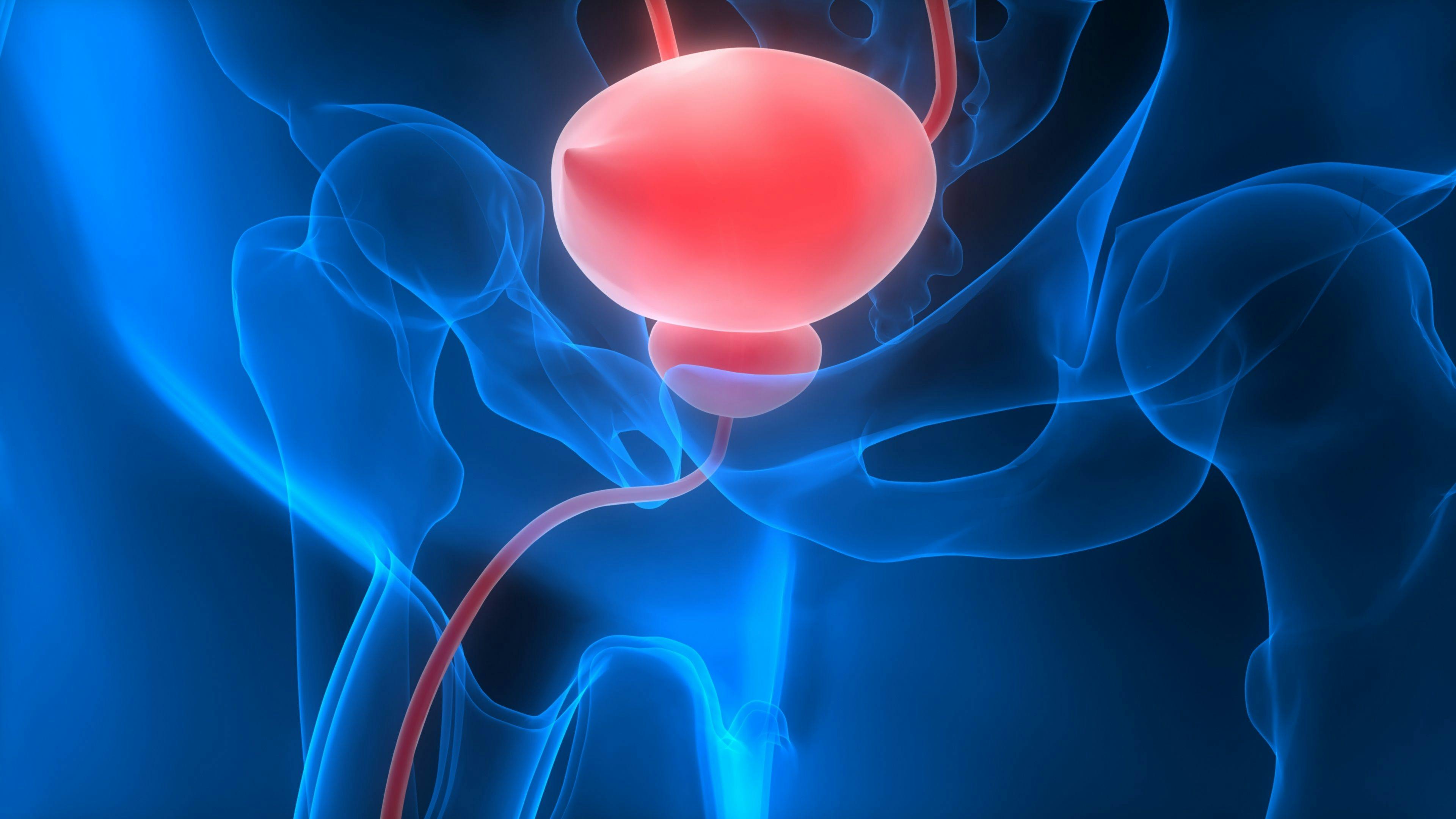 NMI Bladder Cancer Gene Therapy Shows Promising Safety and Efficacy in Phase 1 Trial
