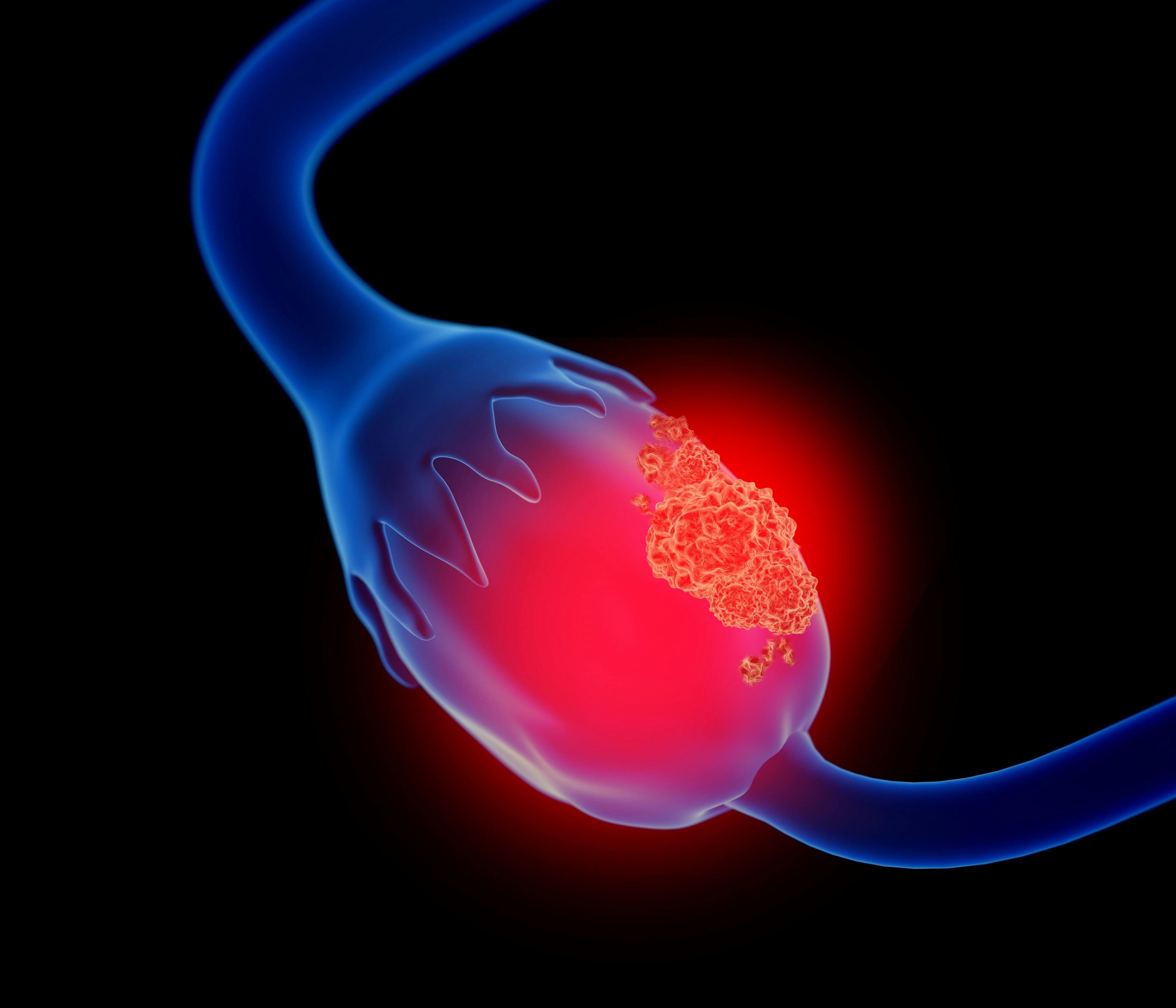 Anixa Makes Progress in CER-T Trial for Ovarian Cancer