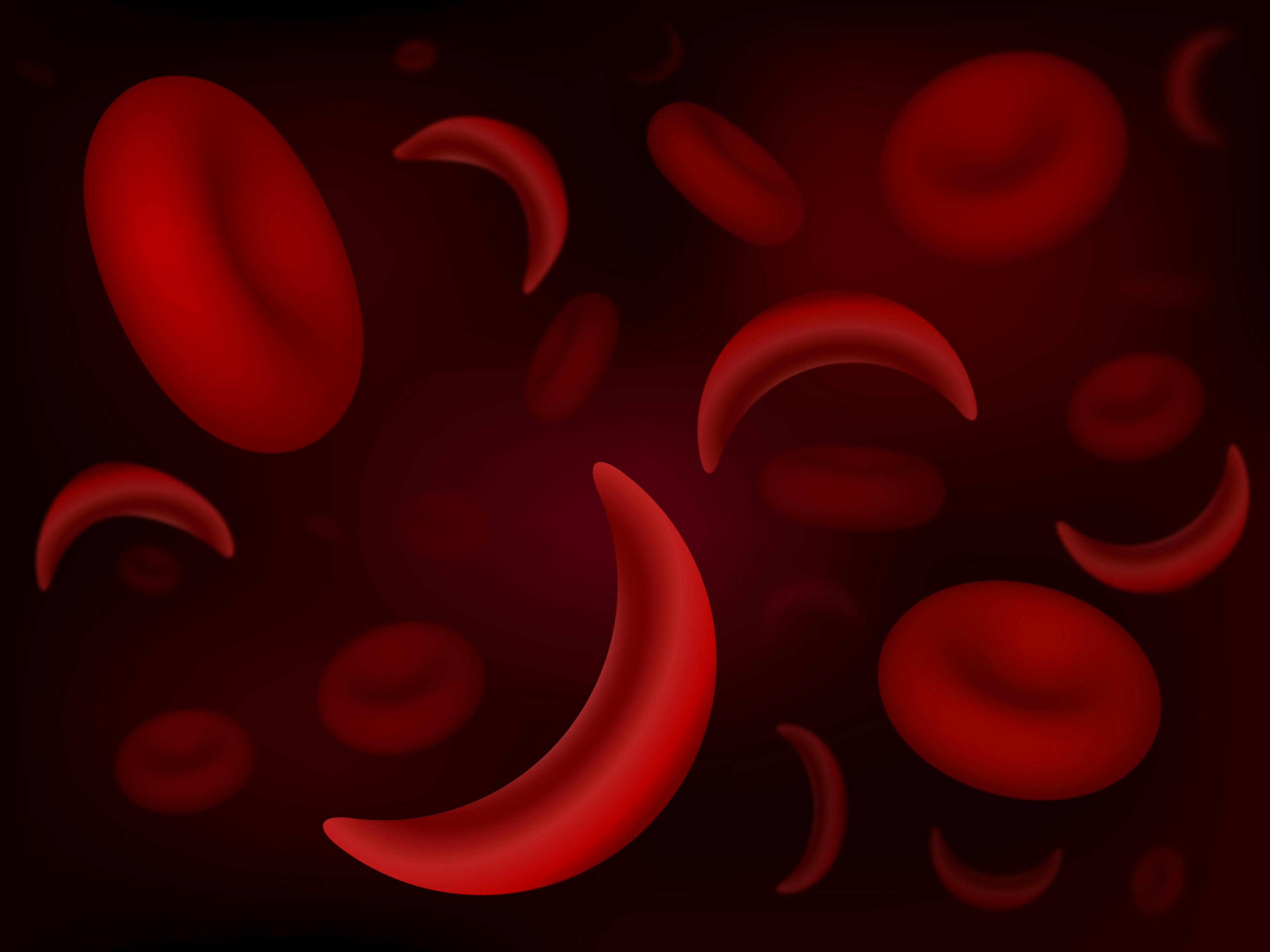 Gene Edited Cell Therapy Improves Fetal Hemoglobin Expression in Patients With Sickle Cell Disease