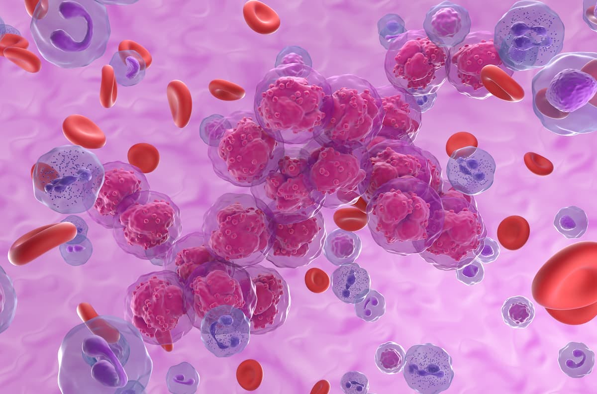 CAR-T WU-CART-007 Shows Evidence of Antileukemic Activity Among Patients With T-ALL/LBL