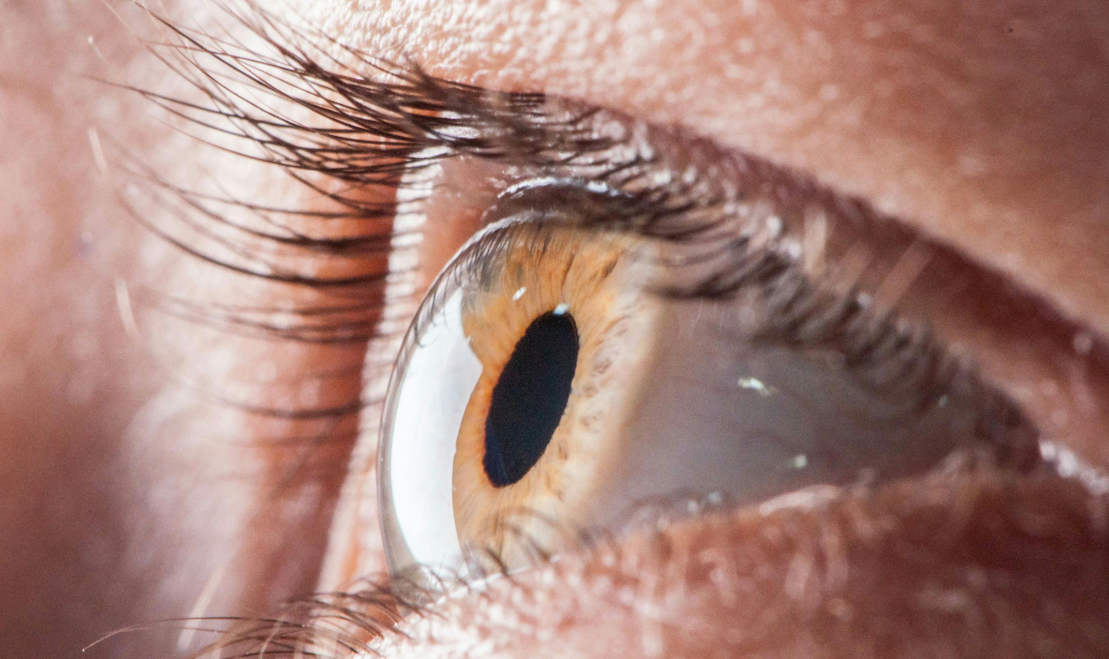 Cell Therapy a Promising Option in Corneal Endothelial Disease