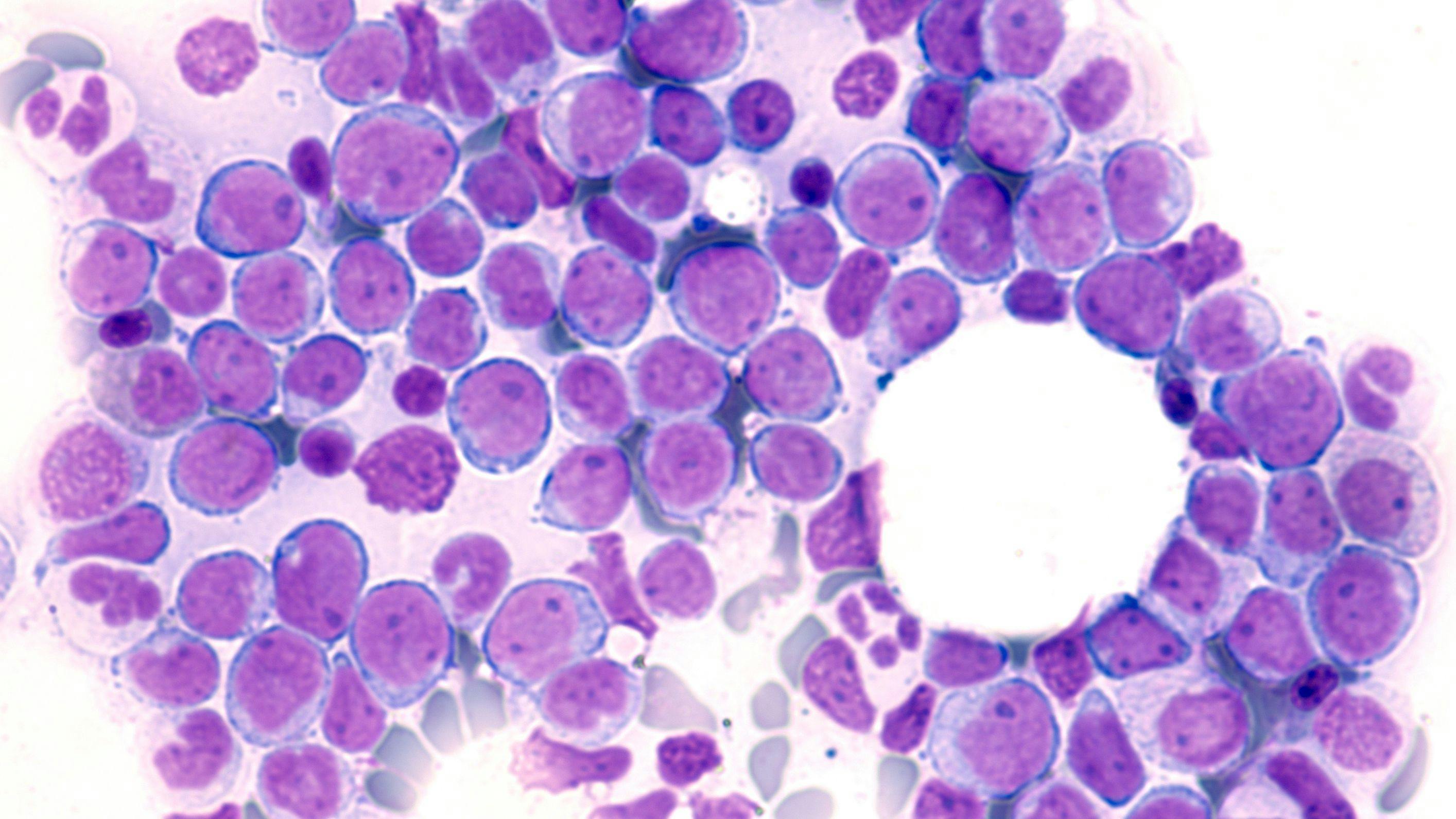 Cell Therapy for AML Granted Fast Track Designation