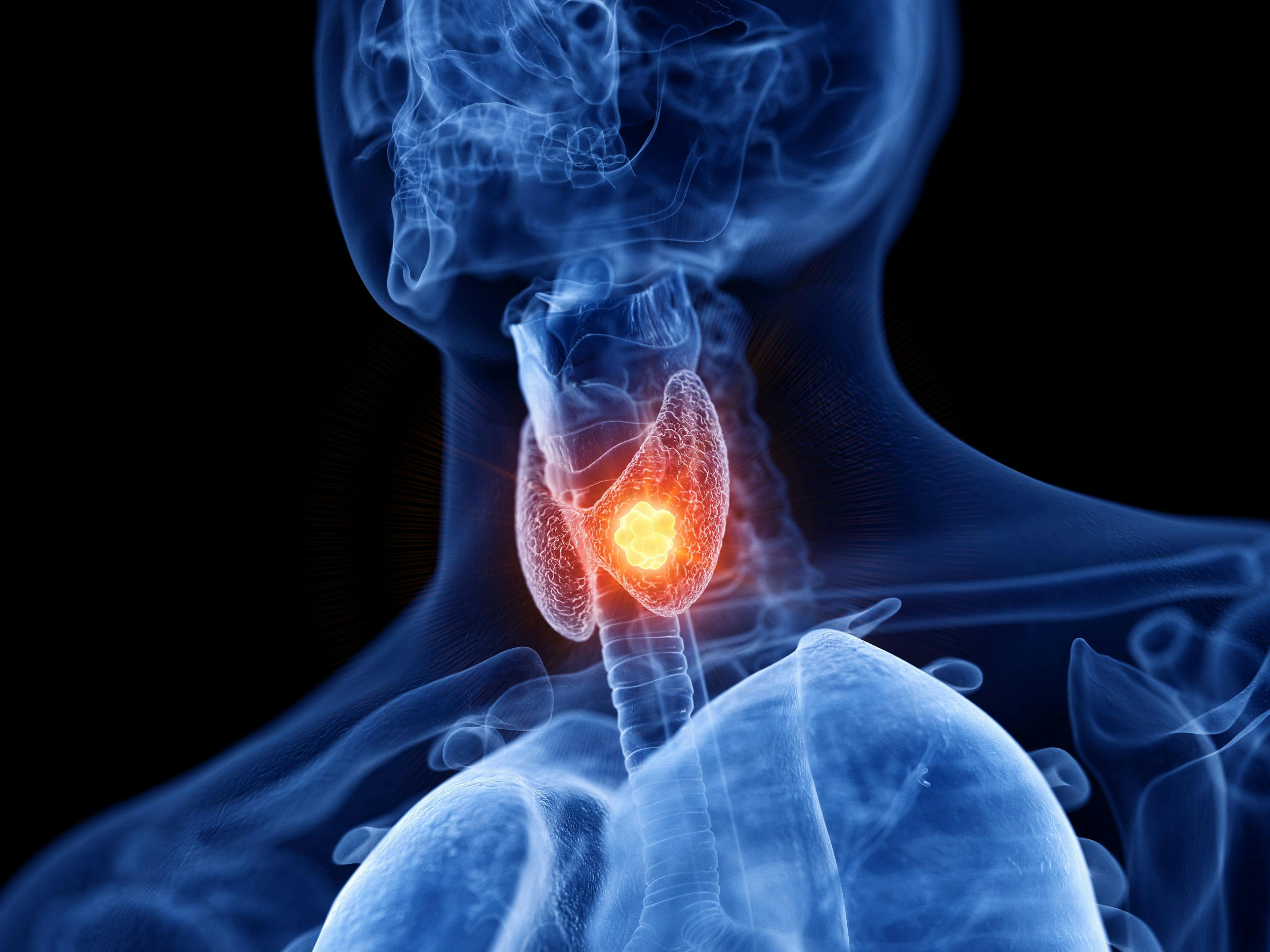 First Study of CAR T in R/R Thyroid Cancer Underway