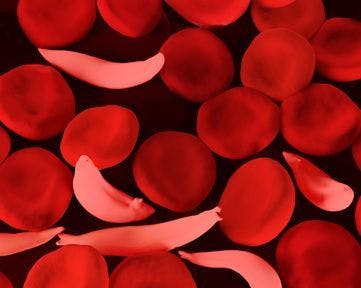 UniQure Hopes Etranacogene Dezaparvovec Clears Concerns as They Plan FDA Submission for Hemophilia B