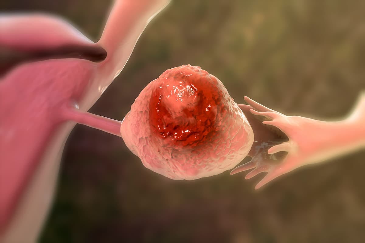 FDA Fast Tracks Avenge Bio’s Ovarian Cancer Cell Therapy AVB-001