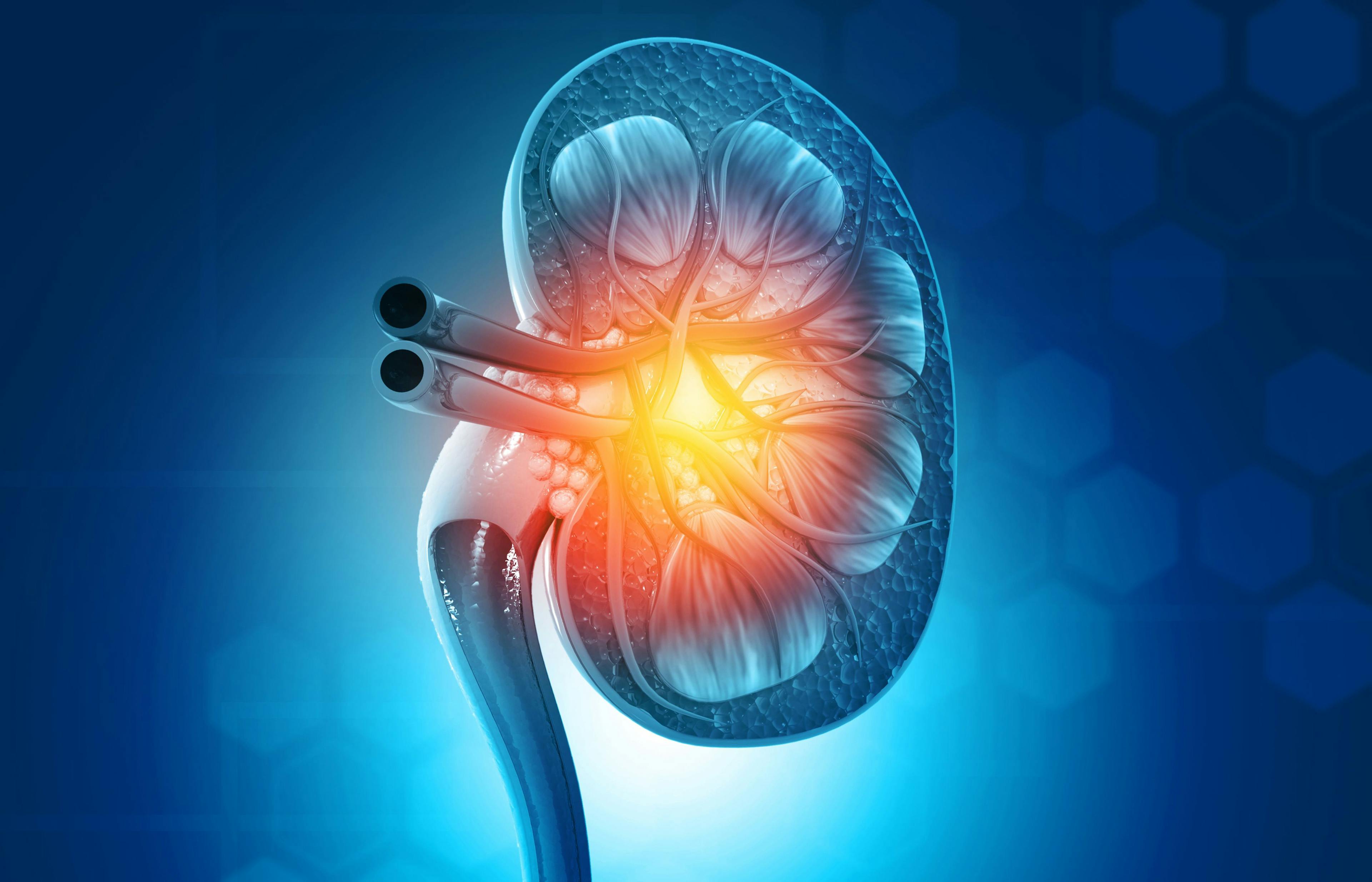 MSC Therapy Shows Promise in Diabetic Kidney Disease