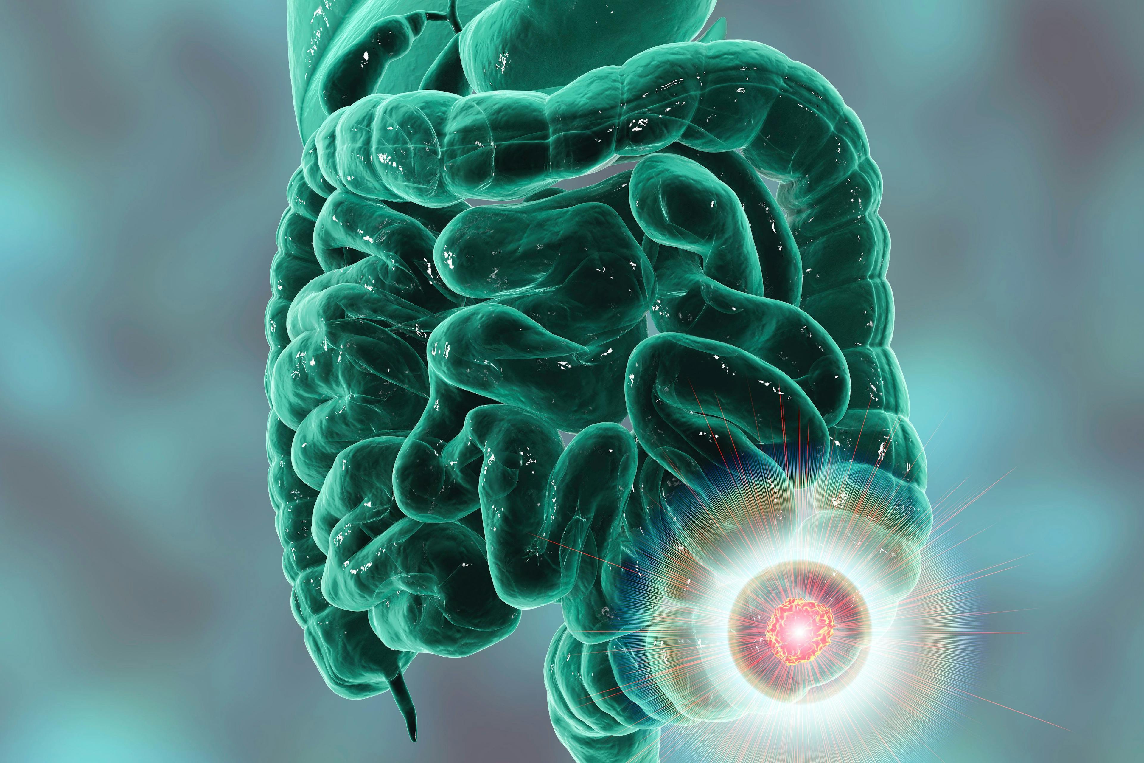 Celyad Discontinues CYAD-101 for Metastatic Colorectal Cancer